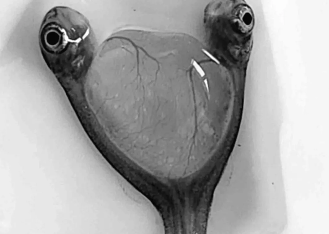 Дві голови, одне тіло: неймовірне відкриття вчених зі світу сіамських близнюків